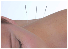 The British Medical Acupuncture Society